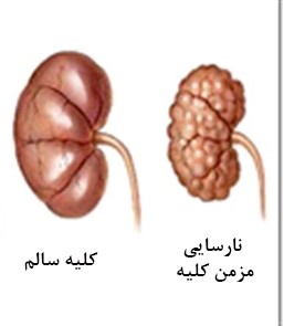 نارسایی مزمن کلیوی 